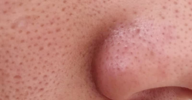 Enlarged pores on facial skin