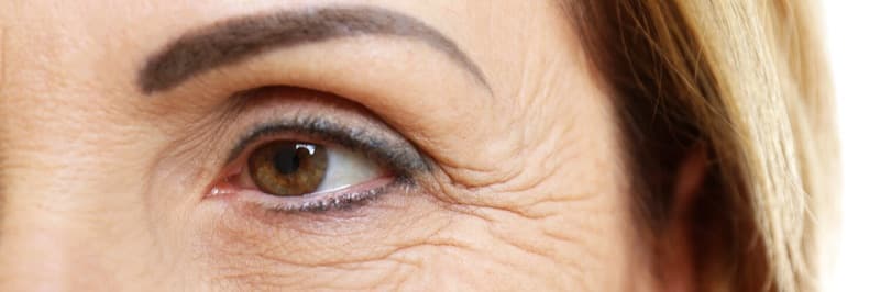 Fine lines and wrinkles around the eye