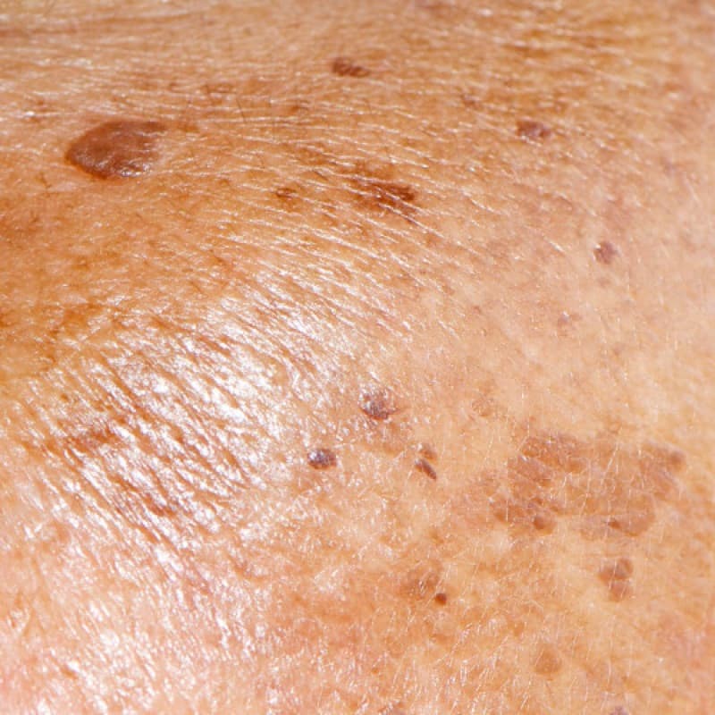 Skin hyperpigmentation close-up