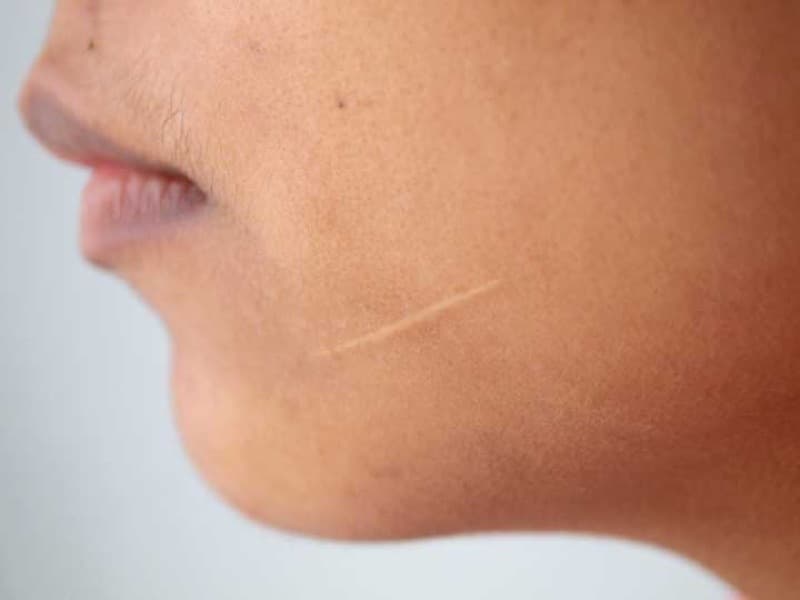 Facial scarring close-up