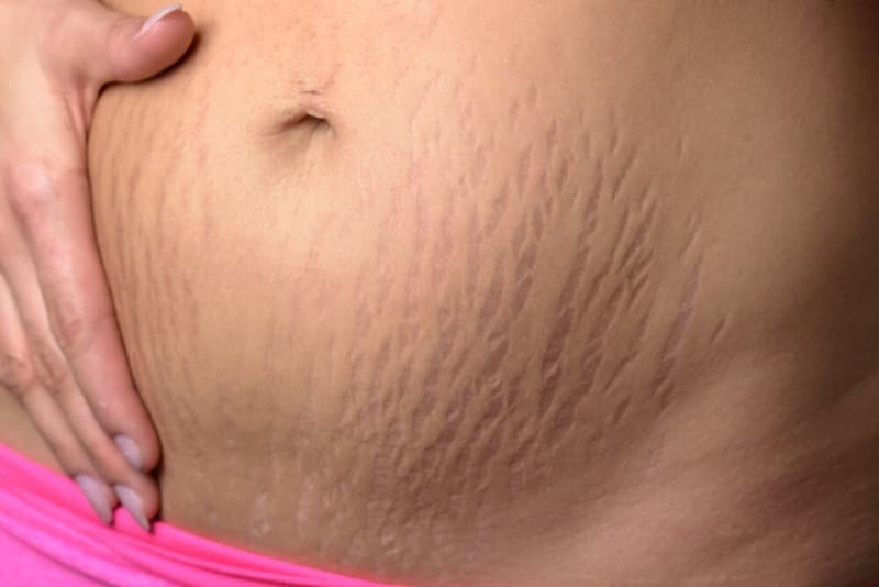 Stretch marks on skin