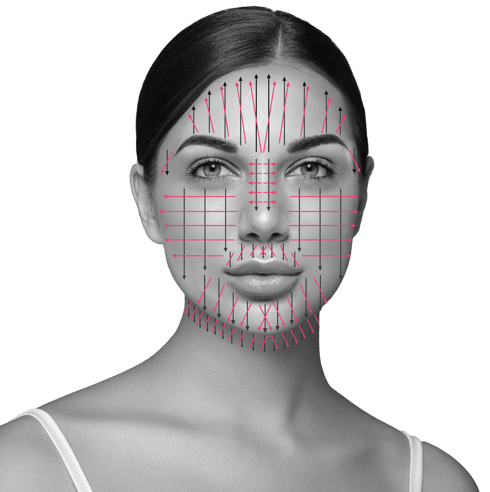 Treatment direction face map showing needling directions across facial regions